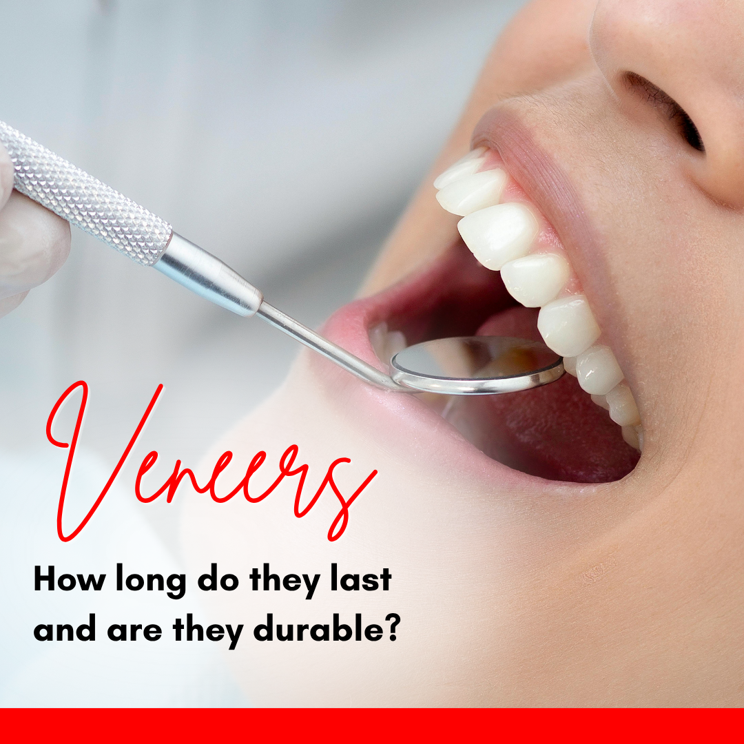 veneers durability