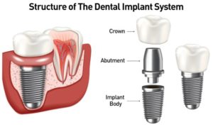An illustration outlining the internal structure of a dental implant. 