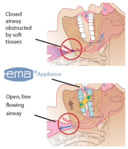 An illustration showing a the difference between a closed airway and an open one. 