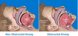 An illustration showing the difference between an obstructed airway vs. a non-obstructed airway.