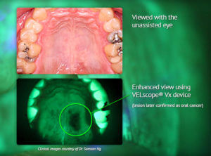 Oral cancer screening image