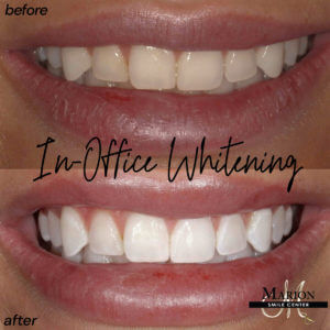 teeth whitening process before and after