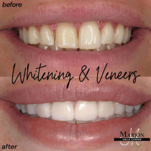 before and after of a whitening and veneers dental procedure