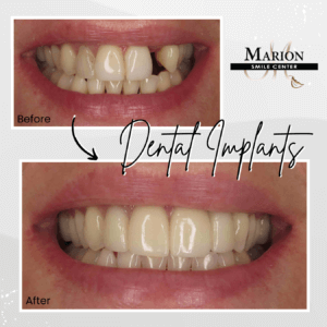 dental implant before and after 