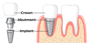 visual of dental implant 