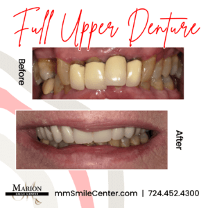 full upper denture before and after