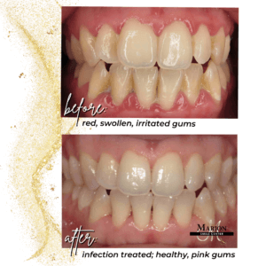 Gum Therapy Before And After